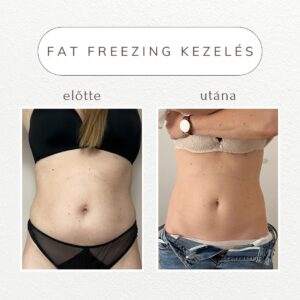 vital-shape-fat-freezing-referencia