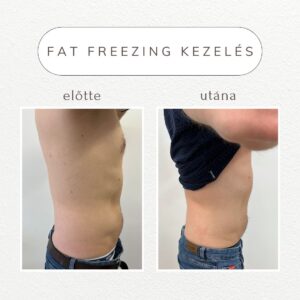 vital-shape-fat-freezing-referencia