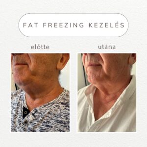 vital-shape-fat-freezing-referencia